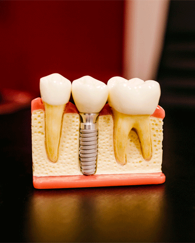 Dentures and Dental Implants